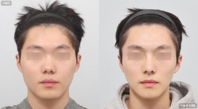 before-after photo rhinoplasty-nose-job