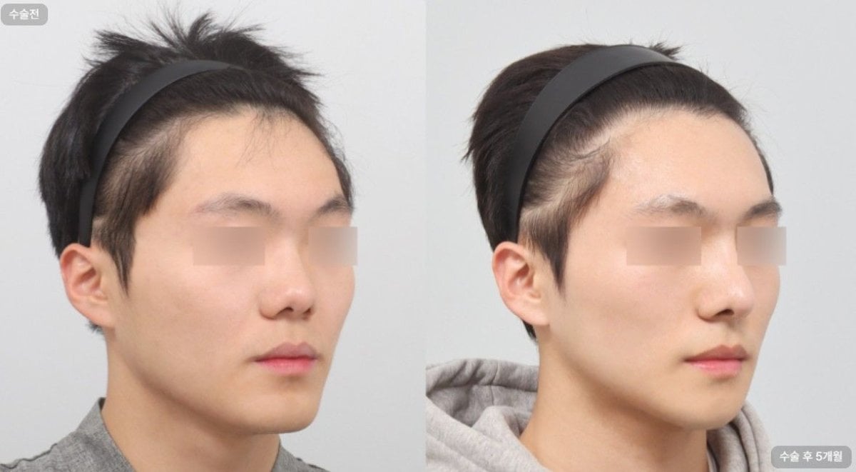 نتائج زراعة الشعر قبل وبعد في AB Plastic Surgery Clinic، كثافة خط الشعر المحسنة