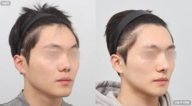 before-after photo rhinoplasty-nose-job