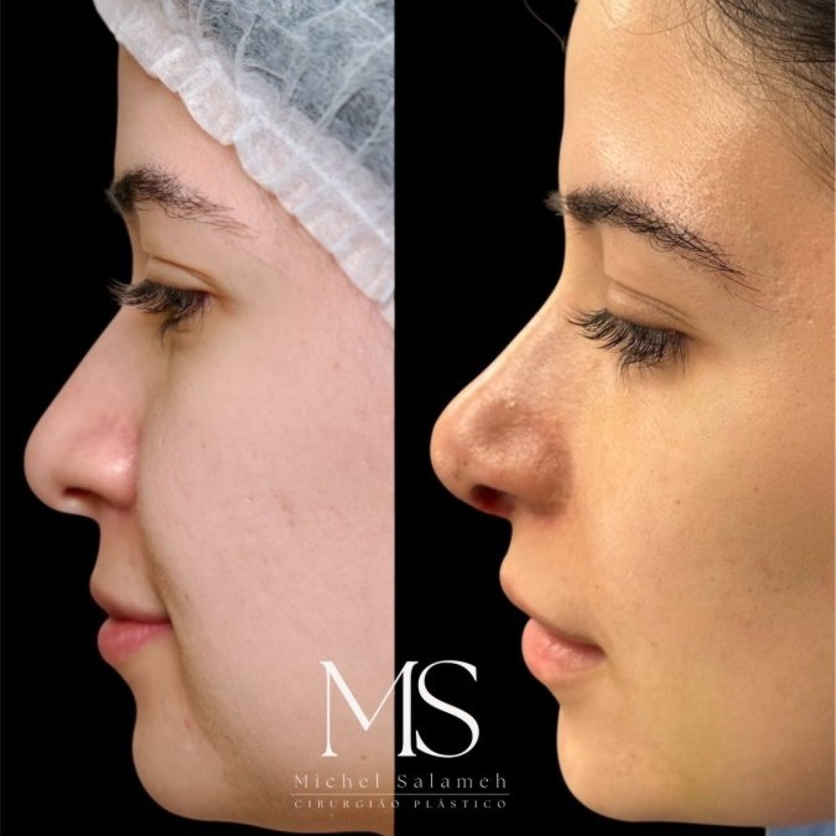 Resultados de rinoplastia antes y después en Dr. Michel Salameh - Plastic And Aesthetic Surgery