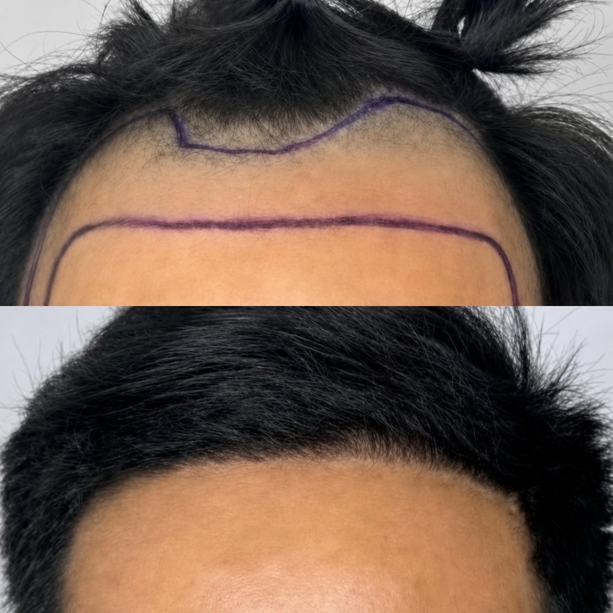 Resultados de trasplante capilar antes y después en Somchai Clinic, línea de cabello restaurada
