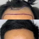 نتائج زراعة الشعر قبل وبعد في عيادة سومشاي، خط شعر مستعاد وكثافة أعلى