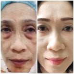 Результаты блефаропластики верхних век до и после в Somchai Clinic, омоложение глаз