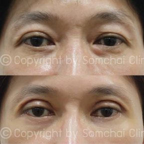 Результаты блефаропластики до и после в клинике Somchai, коррекция век для молодого взгляда