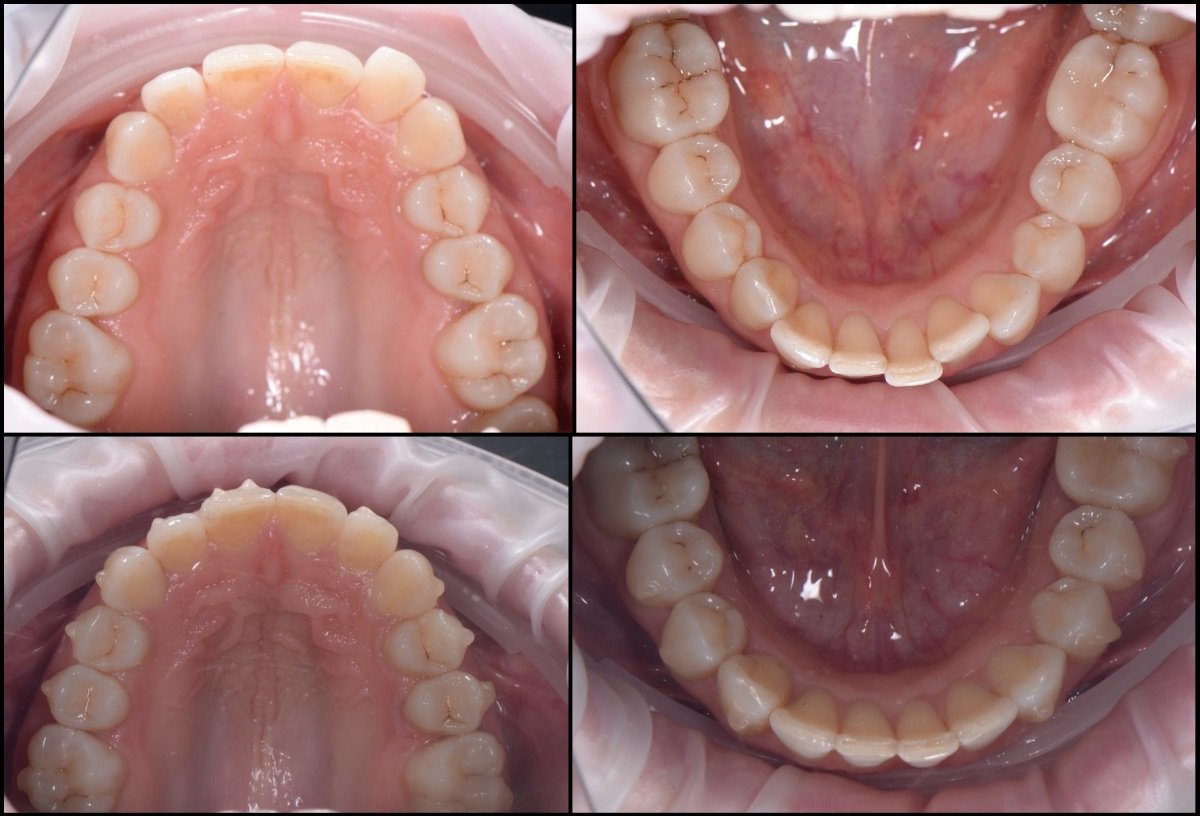 Resultados antes y después de alineadores transparentes en RIKOTA Dental Clinic, mejor alineación