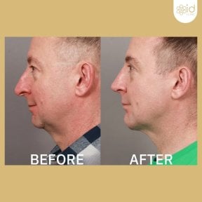 before-after photo maskulinizaciya-lica