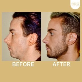 before-after photo maskulinizaciya-lica