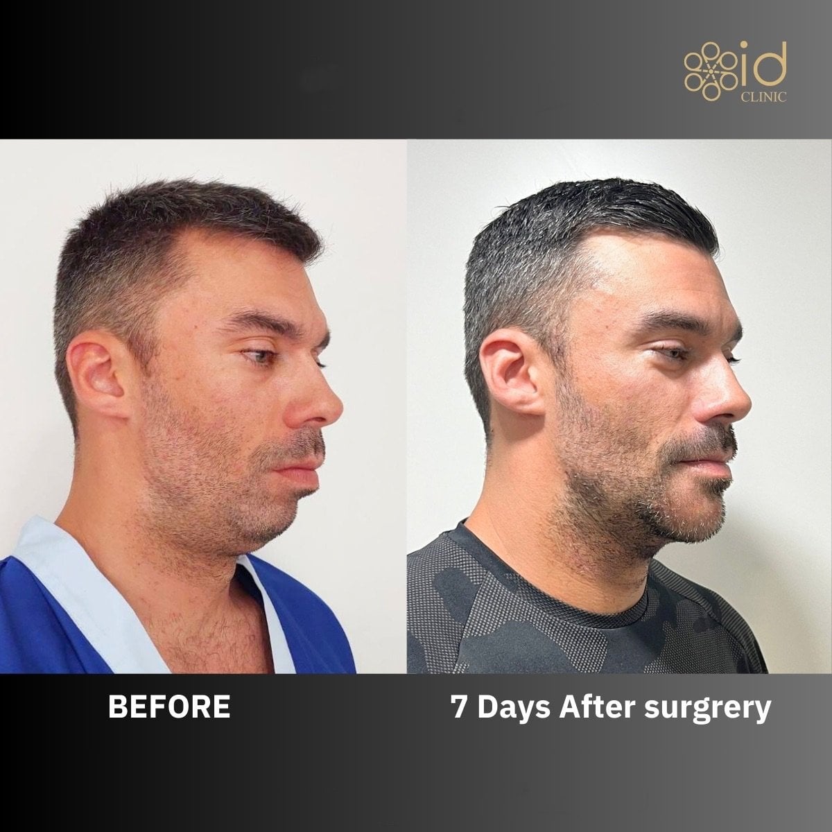 Resultados de masculinización facial antes y después en ID Clinic Bangkok, mandíbula mejorada