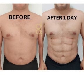 before-after photo vaser-liposakcia