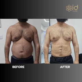before-after photo vaser-liposakcia