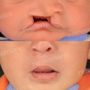 before-after photo plastika-rasseplenia-neba-ili-guby
