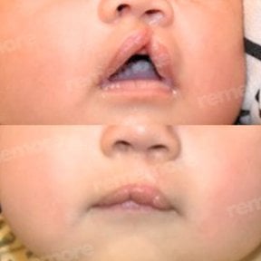 before-after photo plastika-rasseplenia-neba-ili-guby