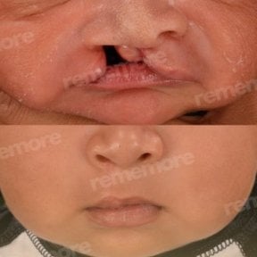 before-after photo plastika-rasseplenia-neba-ili-guby