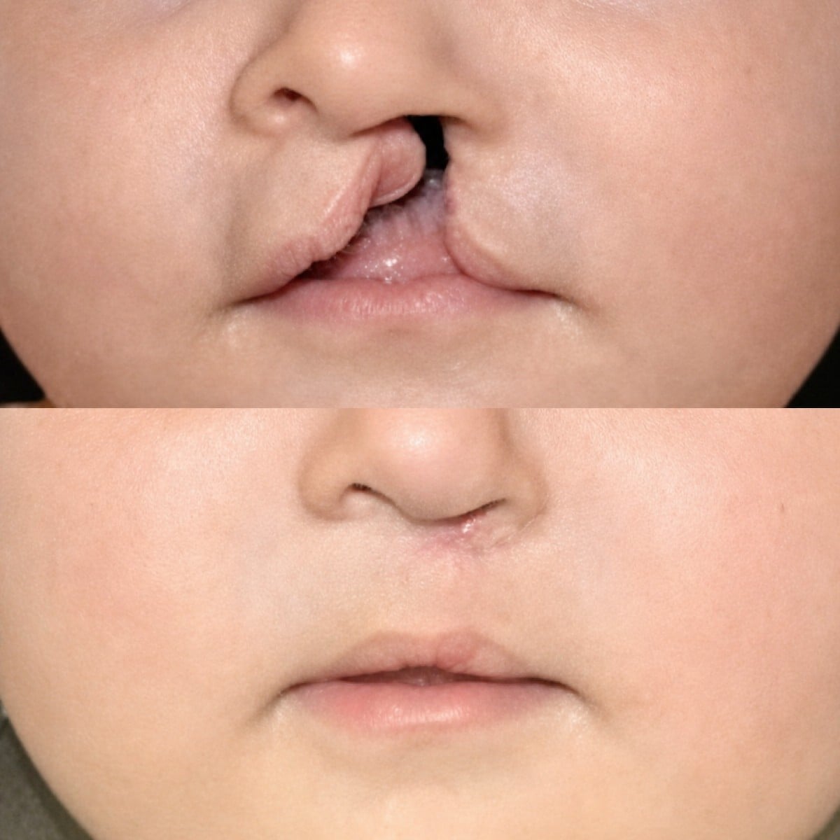 Resultados antes y después de reparación de labio leporino en Memorial Ankara Hospital