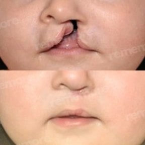 before-after photo plastika-rasseplenia-neba-ili-guby