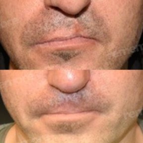 before-after photo plastika-rasseplenia-neba-ili-guby