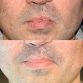 before-after photo plastika-rasseplenia-neba-ili-guby