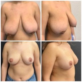 before-after photo breast-reduction