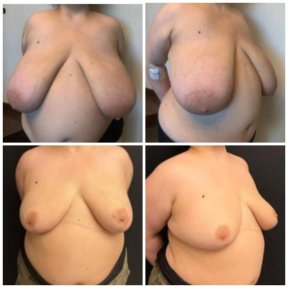 before-after photo breast-reduction