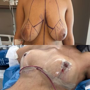 before-after photo breast-reduction