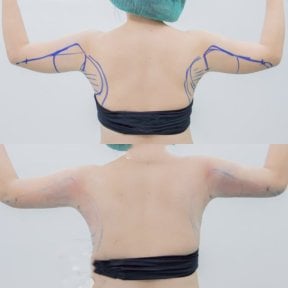 Before and after Vaser liposuction arm contouring results at Cosmacare clinic
