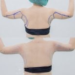 Before and after Vaser liposuction arm contouring results at Cosmacare clinic