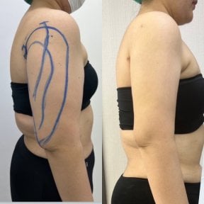 Before and after Vaser liposuction arm contouring results at Cosmacare clinic