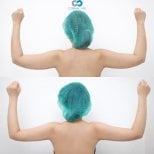 Before and after Vaser liposuction arm results at Cosmacare clinic, improved arm contour