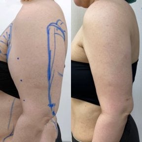 Before and after Vaser liposuction arm contouring results at Cosmacare clinic