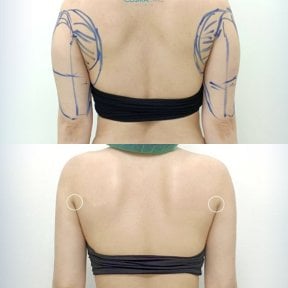 Before and after Vaser liposuction arm contouring results at Cosmacare clinic