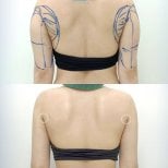 Before and after Vaser liposuction arm contouring results at Cosmacare clinic