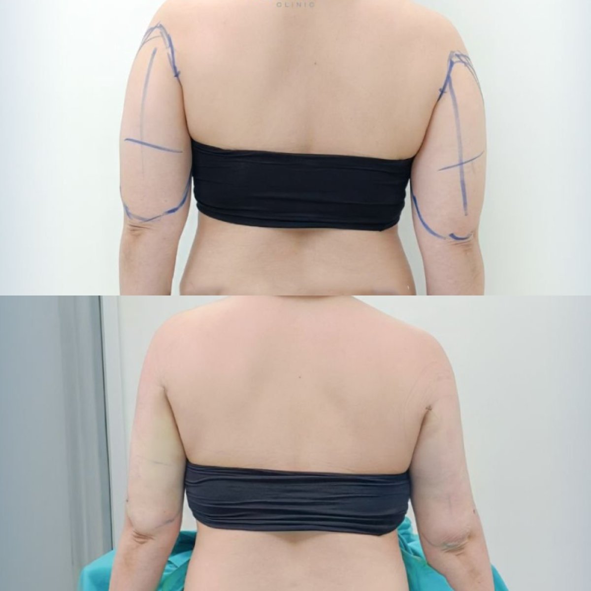 Resultados antes y después de lipoescultura Vaser en brazos en Cosmacare clinic
