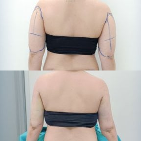 Before and after Vaser liposuction arm contouring results at Cosmacare clinic