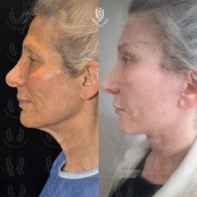 before-after photo glubokaya-podtyazhka-lica-deep-plane-facelift
