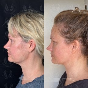 before-after photo glubokaya-podtyazhka-lica-deep-plane-facelift