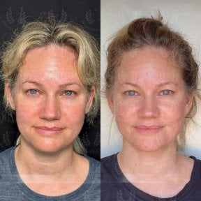 before-after photo glubokaya-podtyazhka-lica-deep-plane-facelift