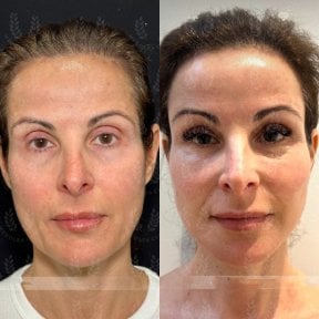 before-after photo glubokaya-podtyazhka-lica-deep-plane-facelift