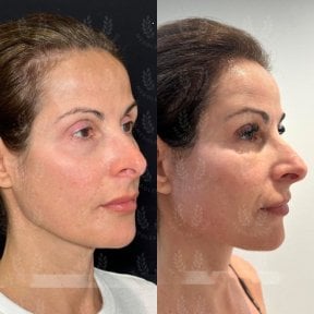 before-after photo glubokaya-podtyazhka-lica-deep-plane-facelift