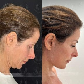 before-after photo glubokaya-podtyazhka-lica-deep-plane-facelift