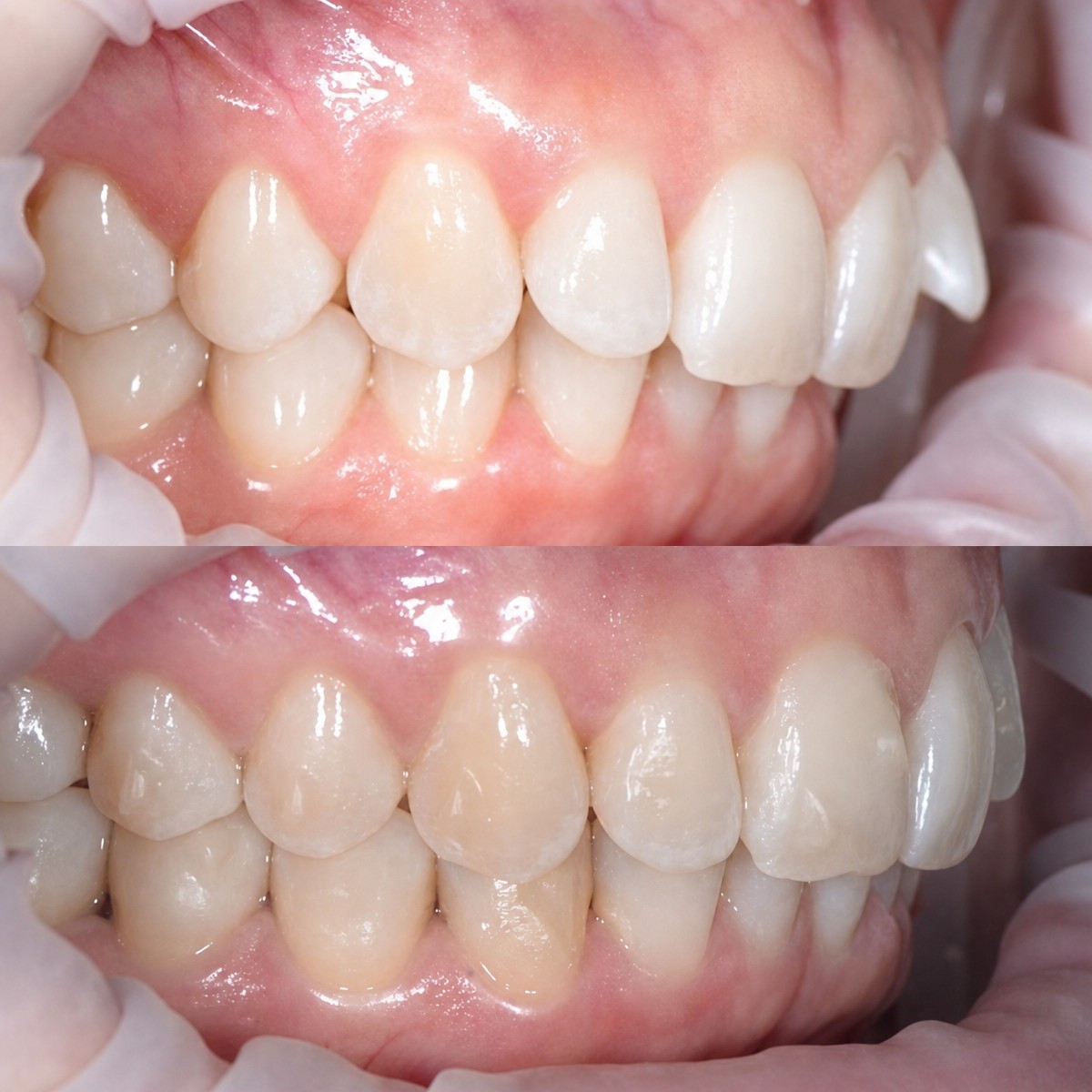 Resultados antes y después de alineadores transparentes en RIKOTA Dental Clinic – alineación dental
