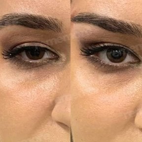 before-after photo plastika-verhnego-veka