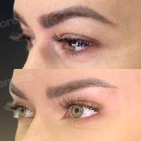 before-after photo plastika-verhnego-veka