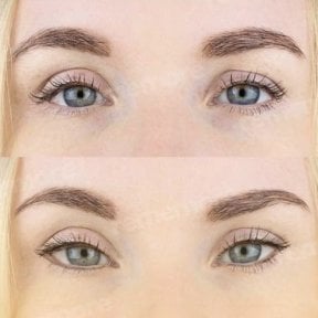 before-after photo plastika-verhnego-veka