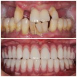 Resultado antes y después de implantes dentales All-on-4 – restauración total de la sonrisa
