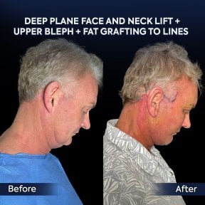 before-after photo glubokaya-podtyazhka-lica-deep-plane-facelift