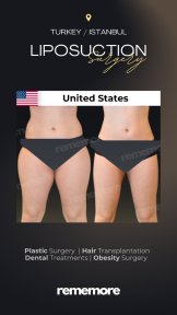 before-after photo liposuction