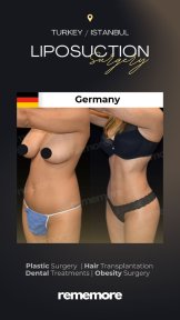 before-after photo liposuction
