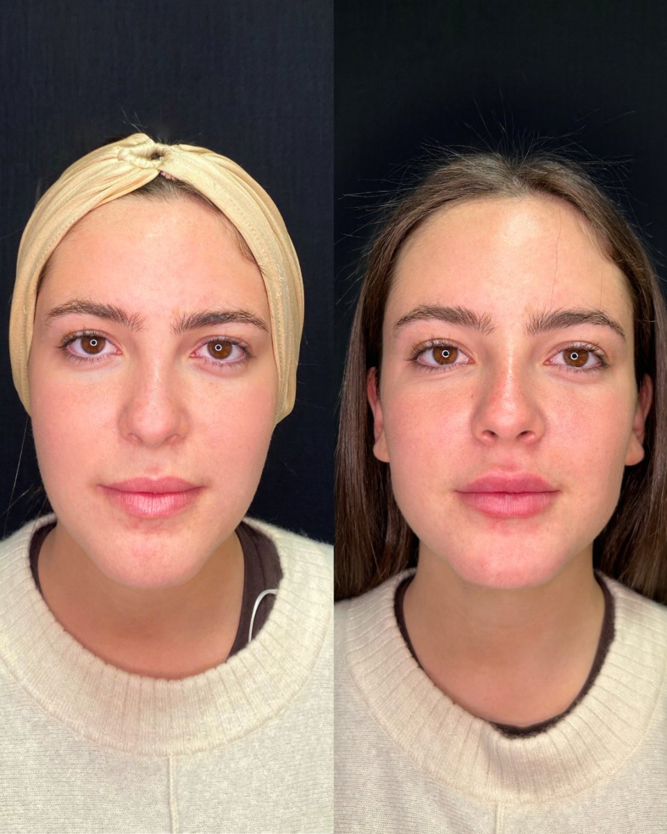 Resultado antes y después de rellenos dérmicos: labios y contorno facial mejorados