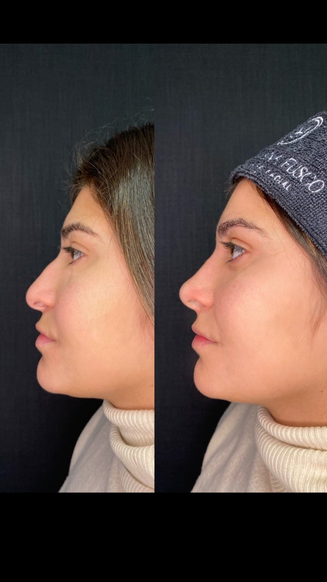 نتائج قبل وبعد تجميل الأنف بالفيلر – تعديل الأنف بدون جراحة بمظهر طبيعي