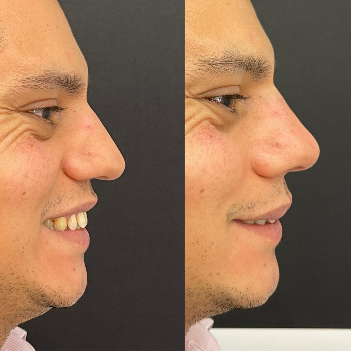 Resultados antes y después de rinoplastia con relleno, remodelación nasal sin cirugía